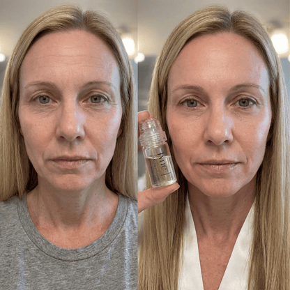 Micro-Infusion 1 Month Bundle – | Fyne Skincare